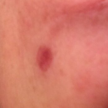 Marmur Medical - Time to Gross you out with my Face. On Right Cheek from Sun Worship. 03/07/17 - Dermatologists Near Me - New York, New York Marmur Medical - Time to Gross you out with my Face. On Right Cheek from Sun Worship. 03/07/17 - Dermatologists Near Me - New York, New York