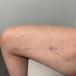 Schu-Fu Martial Arts - Bruises from police brutality by Detective Grove due to false police report made by owner of this place.