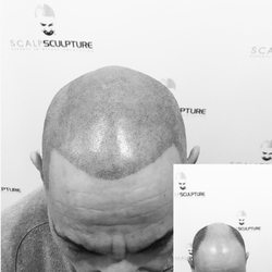 Scalp Sculpture - After 20 year with out a hair, he finally got his hairline back.