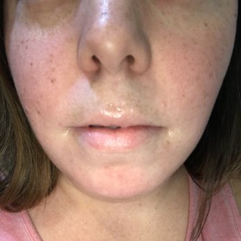 Advanced Aesthetics - Before - Medical Spas Near Me - Las Vegas, Nevada