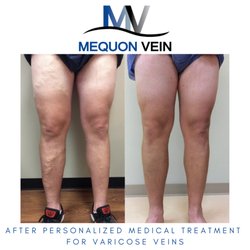 Mequon Vein - Brookfield