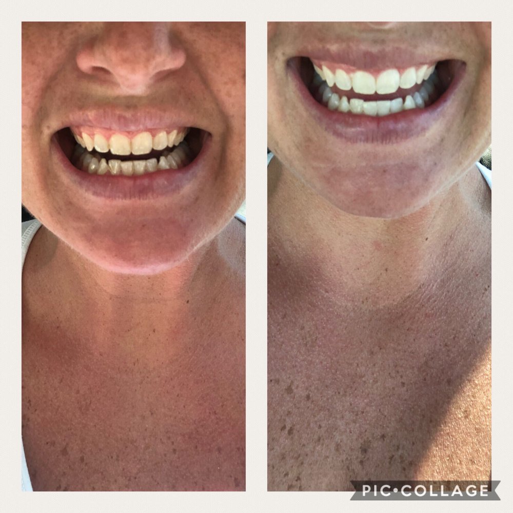 ATLANTIC TEETH WHITENING Updated August 2024 277 N Lynnhaven Rd