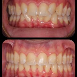 Riviera Orthodontics - Invisalign treatment for a young adult