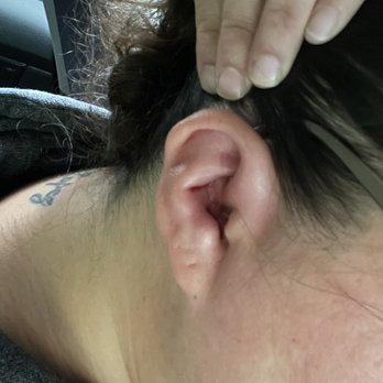 No Egrets Tattoo Studio - Right Ear Right after Removal - Tattoo Near Me - Clarksville, Tennessee No Egrets Tattoo Studio - Right Ear Right after Removal - Tattoo Near Me - Clarksville, Tennessee