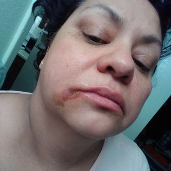 Bradshaw Julie DDS - Do not go to this Dr she left me with cuts bruises abrasions for a simple molar extraction my appointment was at 9:30 she arrived to 11:30 - Oral Surgeons Near Me - Tucson, Arizona Bradshaw Julie DDS - Do not go to this Dr she left me with cuts bruises abrasions for a simple molar extraction my appointment was at 9:30 she arrived to 11:30 - Oral Surgeons Near Me - Tucson, Arizona