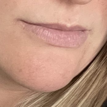 Samara MedSpa Avon/Simsbury - Current lips no filler left that she refused to work on until "dissolved". - Skin Care Near Me - Avon, Connecticut