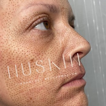 Nuskin Fibroblast - Full face rejuvenation - Acne Treatment Near Me - Oceanside, California