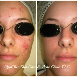 Opal Tree Skin Care & Acne Clinic - Graduate - Acne Edge Program