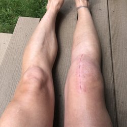 Howell Stephen M MD - My knee 4 weeks out.