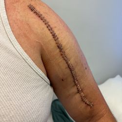 Fort Pierce Orthopaedics - My husband shattered his humerus. Dr Barry fixed him up. He's gonna have a gnarly scar
