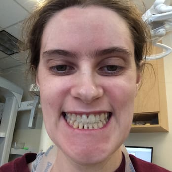 South Bay Orthodontics - Just got my permanent retainer! - Orthodontists Near Me - Cupertino, California South Bay Orthodontics - Just got my permanent retainer! - Orthodontists Near Me - Cupertino, California
