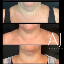 Anne Judge Aesthetics - Morpheus8