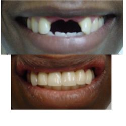 Dental Care 4U - No More Missing Teeth