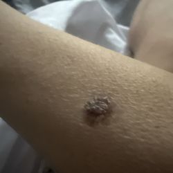 Sienna Dermatology - This is arm spot after SD froze it so the picture is darker now after treatment.