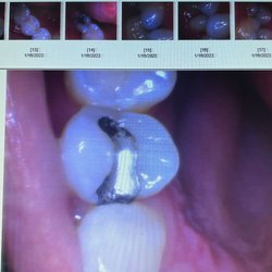 Future Dental Care - Before (my silver fillings)