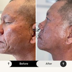 Bio-Micro needling