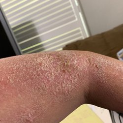 Chinese Medicine Wellness Center of America - Left Arm before Treatment