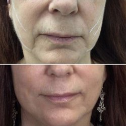 Dermabeauty Medical Spa - Before & After of pdo thread lift