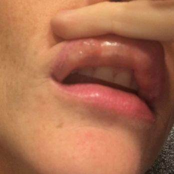 Body Beautiful Laser Medi-Spa - All the filler is just laying in the inside of my lips - Laser Hair Removal Near Me - Bridgewater, Pennsylvania Body Beautiful Laser Medi-Spa - All the filler is just laying in the inside of my lips - Laser Hair Removal Near Me - Bridgewater, Pennsylvania