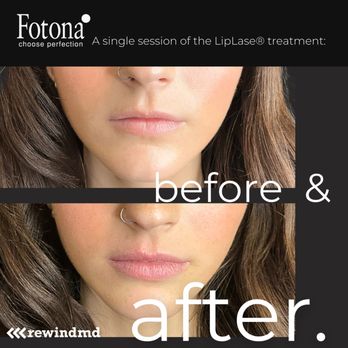 RewindMD - Achieve the perfect pout with our non-invasive Liplase® treatment at RewindMD! - Medical Spas Near Me - Cardiff, California