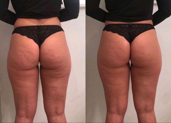 Non Invasive Booty Lift - Non Invasive Booty Lift