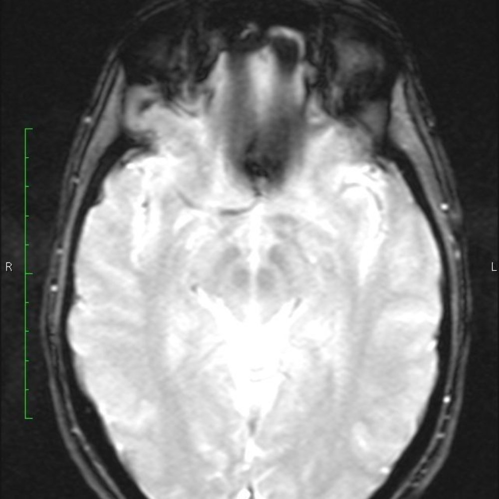 Theresa Keefe, DMD - MRI 12/26/14 When left untreated, jawbone lymphoma ends up giving you devastating symptoms of CFS and intractable migraines. - Periodontists Near Me - Canton, Connecticut