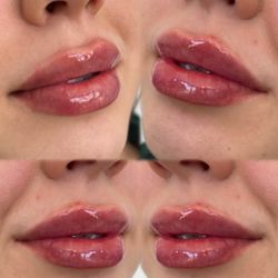 dermani MEDSPA® Mansfield - Lip filler