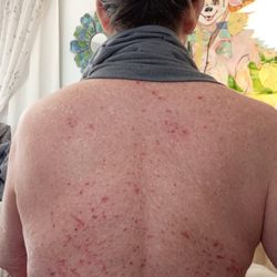 Ent Specialists - Exzema flare as a result of being prescribed a post-op pain med that I told the surgeon I was allergic to. He completely disregarded it.