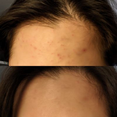 Acne Institute by null