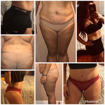 Mommy Makeover Atlanta Marietta Georgia GA