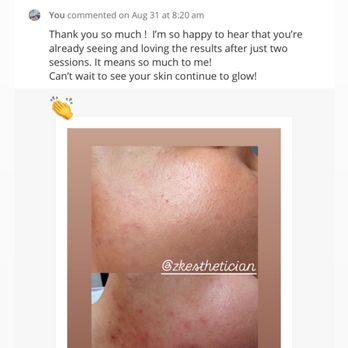ZK Esthetician - Chemical peel - Skin Care Near Me - Tustin, California ZK Esthetician - Chemical peel - Skin Care Near Me - Tustin, California