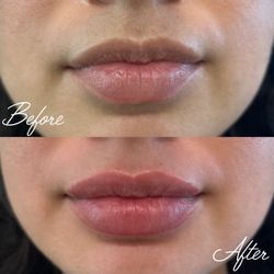 Beauty & The Babe - Lip filler