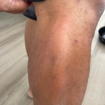 El Torito - Already swelling from the mosquito bites on my husband's leg - Mexican Near Me - Riverside, California El Torito - Already swelling from the mosquito bites on my husband's leg - Mexican Near Me - Riverside, California