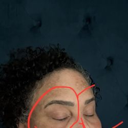 Truesdale Facial Plastic Surgery - Eye hollow after upper and lower eye lift