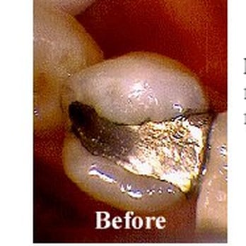 Irving J Leonard, DDS - Defective Silver Amalgam Filling - Oral Surgeons Near Me - Chicago, Illinois