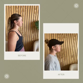 Avella Beauty - Cryo One Chin Sculpting Results after 5 Sessions - Eyelash Service Near Me - Phoenix, Arizona