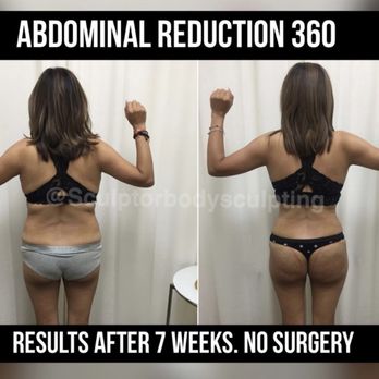 Sculptor Body - Weight Loss Centers Near Me - Downey, California Sculptor Body - Weight Loss Centers Near Me - Downey, California