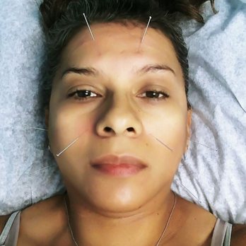 Shen's Acupuncture - Acupunture for sinus and TMJ sooo relaxing, I am one happy and relaxed client - Acupuncture Near Me - Modesto, California Shen's Acupuncture - Acupunture for sinus and TMJ sooo relaxing, I am one happy and relaxed client - Acupuncture Near Me - Modesto, California