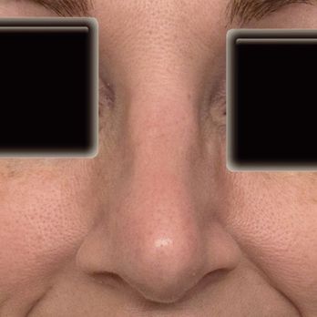 Finn Plastic Surgery - Cosmetic Surgeons Near Me - Chapel Hill, North Carolina Finn Plastic Surgery - Cosmetic Surgeons Near Me - Chapel Hill, North Carolina