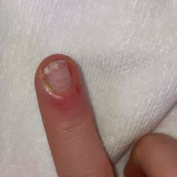 Infected finger nail