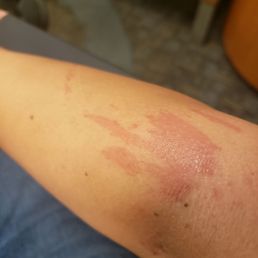 1st degree burns 1st degree burns