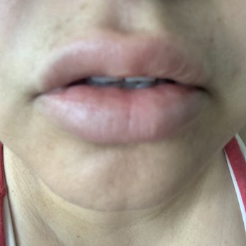Youthology - Bumps on lower lip . - Medical Spas Near Me - Bakersfield, California Youthology - Bumps on lower lip . - Medical Spas Near Me - Bakersfield, California