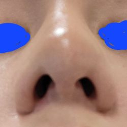 Michel Siegel: Facial Center for Plastic Surgery - Rhinoplasty results