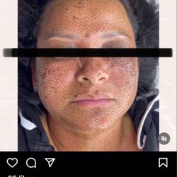 Vivi Dieppa - The day of the procedure and once I contacted her over my hyperpigmentation she deleted the post.