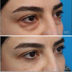 Justin Karlin, MD - Lower Blepharoplasty