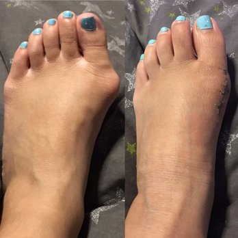 Matthew M Do, DPM - Pictured: Before surgery and 3 weeks post-op - Podiatrists Near Me