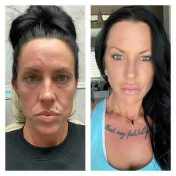 Skin Theory - Before & next day! I just had on tinted moisturizer, mascara and clear lipgloss - Laser Hair Removal Near Me - Corona, California