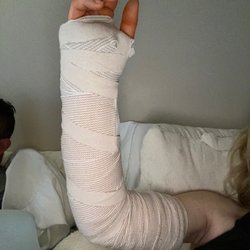 This is the cast my real doctor put me in after surgery.