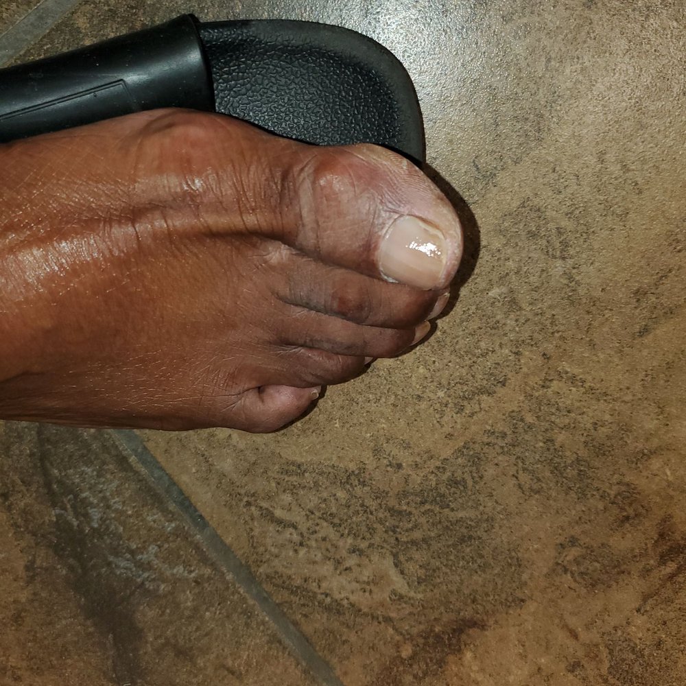 Dead skin on my big toe Dead skin on my big toe