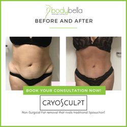 Body Bella Wellness Center - CryoSculpt 45 day before and after of abdomen  and love handles.